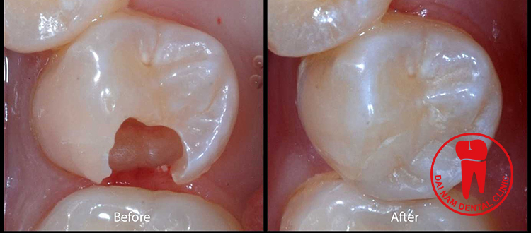 Hình ảnh trước và sau khi trám răng thẩm mĩ - Tùy vào cơ địa mỗi người mà có kết quả khác nhau