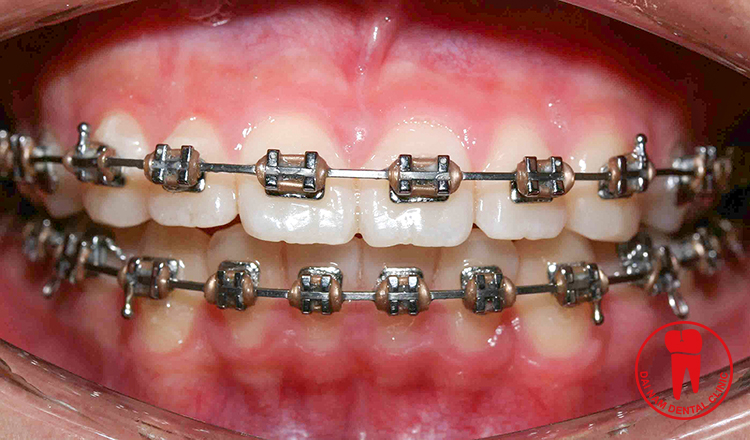 Niềng răng được áp dụng cho trường hợp răng lệch lạc, hô, móm