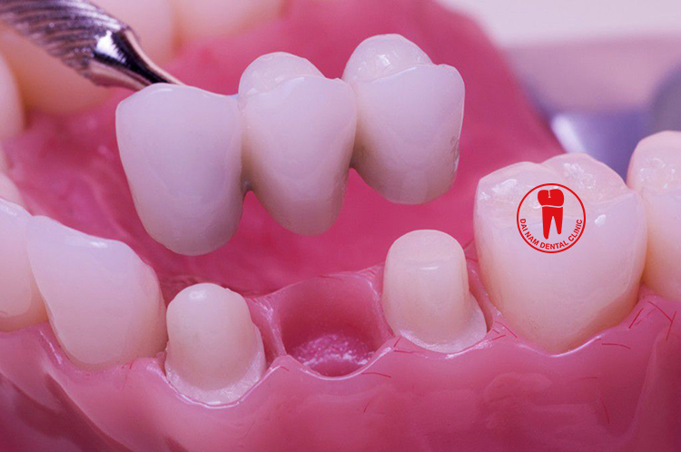 Phương pháp cầu răng sứ dành cho người mất răng