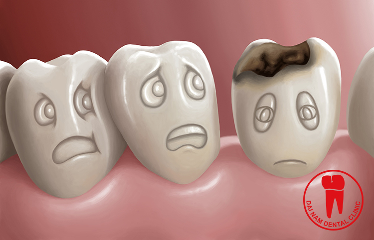Hơn 85% người dân mắc bệnh sâu răng