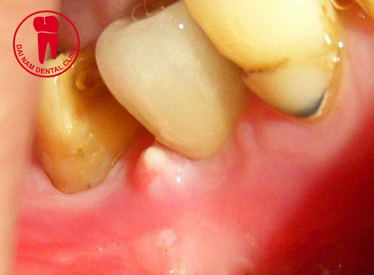 Hiện tượng tụt nướu làm lộ phần chân răng giúp vi khuẩn bám vào gây ra sâu răng