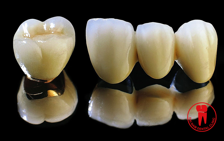 Răng sứ kim loại với khung kim loại bên trong