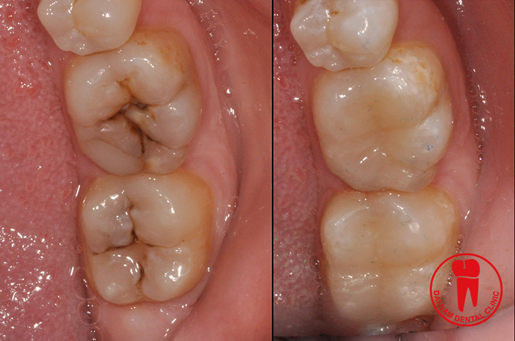 Trám răng inlay mang lại hiệu quả thẩm mỹ cao do có màu sắc trùng với màu của men răng