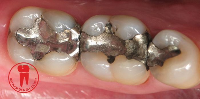 Trám răng bằng vật liệu Amalgam