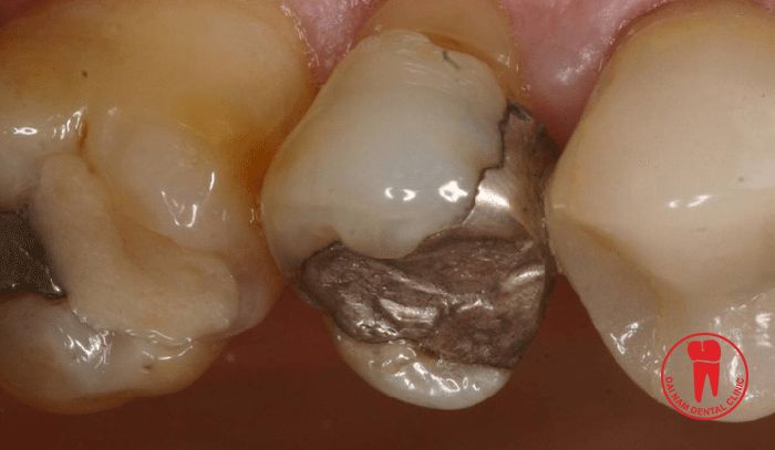 Trám răng Amalgam 