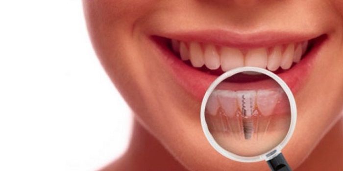 Trồng răng trên Implant