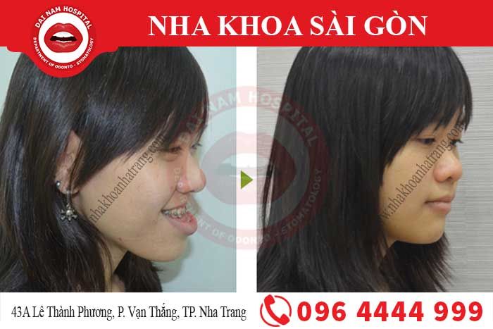 Khách hàng sau khi niềng răng móm