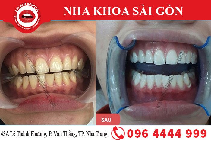 Sau khi tẩy trắng răng tại nhà