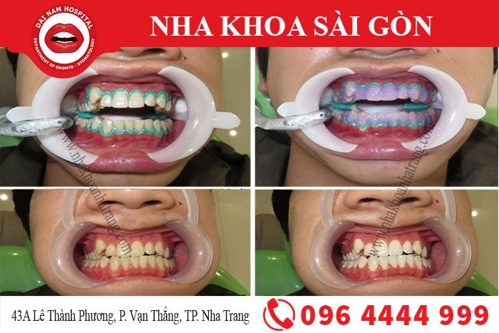 Tẩy trắng răng tại Nha Khoa Sài Gòn